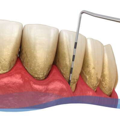 periodoncia-clinica-dental-olmos