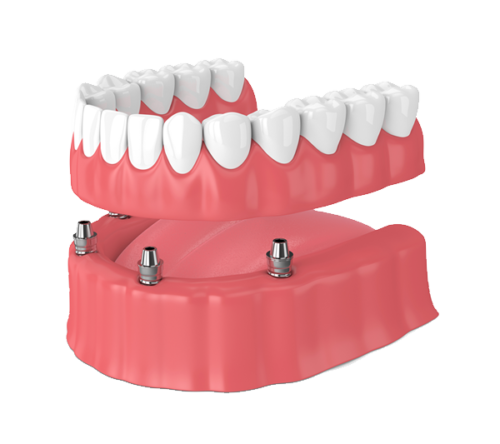 protesis-sobre-implantes-fija