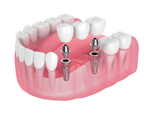 protesis-sobre-implantes-removible